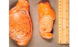 Фото: Что такое гипоплазия яичек