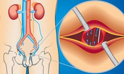 Фото: Варикоцеле вен