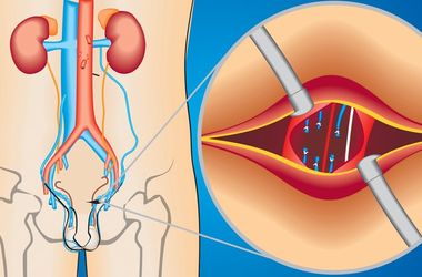 Фото: Варикоцеле вен