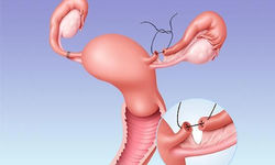 Фото: Диагноз: непроходимость маточных труб