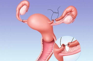 Фото: Диагноз: непроходимость маточных труб