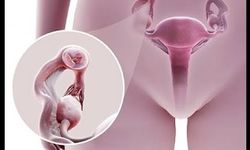 Фото: Внематочная беременность