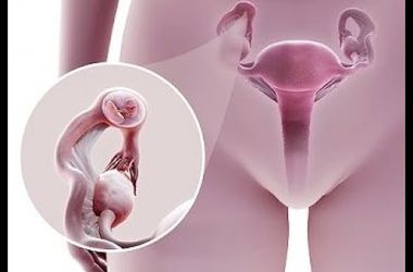 Фото: Внематочная беременность