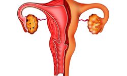 Фото: Что такое кольпит