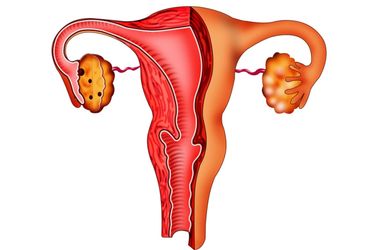 Фото: Что такое кольпит