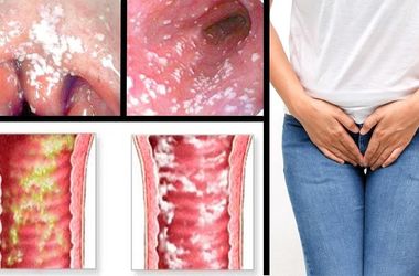 Фото: Вагинит при беременности